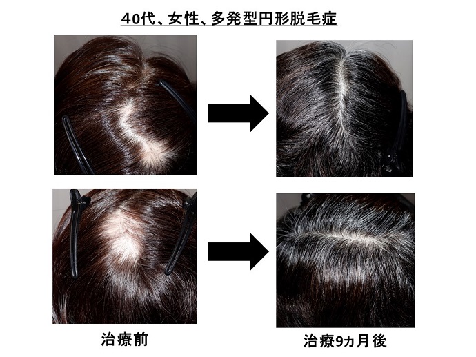 円形脱毛症　病院